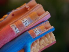 A colocação de stent em todas as artérias bloqueadas supera a abordagem de tratamento apenas do culpado, mostra estudo artéria obstruída