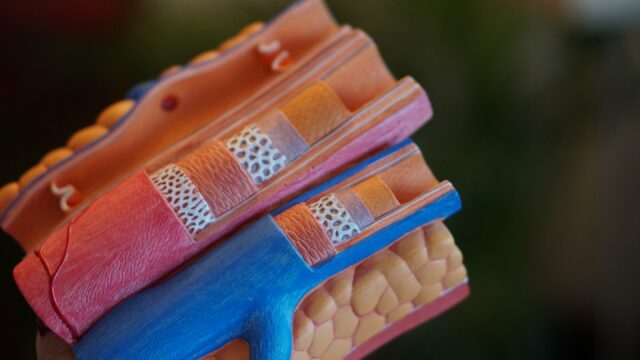 A colocação de stent em todas as artérias bloqueadas supera artéria obstruída