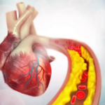 Austrália lidera primeiro teste de terapia de edição genética para reduzir pela metade o colesterol ruim