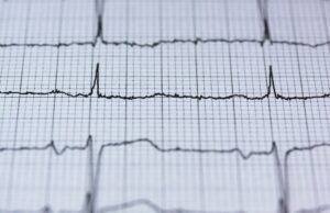 Avaliar a falha no bombeamento cardíaco pode reduzir o risco de acidente vascular cerebral em adultos com doença do músculo cardíaco ritmo cardíaco