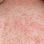 Canadá perde status de livre de sarampo à medida que as taxas de vacinação caem