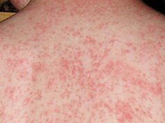 Canadá perde status de livre de sarampo à medida que as taxas de vacinação caem Canadá perde status de livre de sarampo à medida que as taxas de vacinação caem