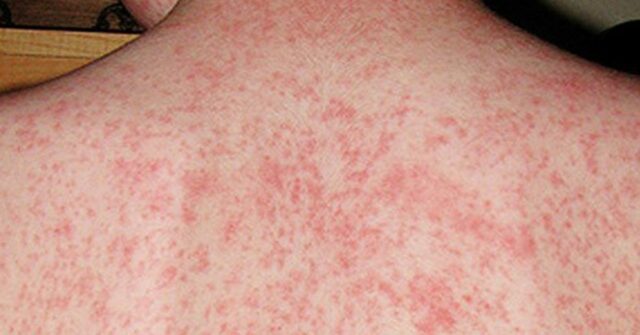 Canadá perde status de livre de sarampo à medida que as taxas de vacinação caem
