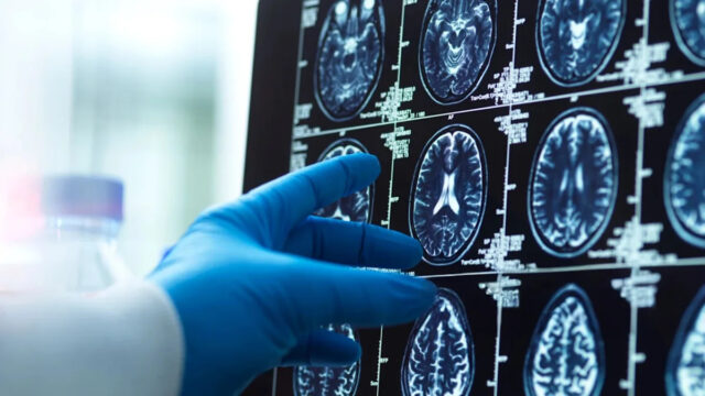 Cientistas ficaram surpresos após descobrirem 'bolhas vítreas' dentro do cérebro Yahoo news home