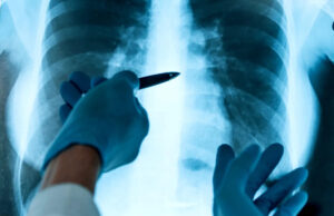 Cientistas preocupados após descoberta ‘surpreendente’ nas profundezas dos pulmões de todas as pessoas vivas: ‘Não esperávamos encontrar (isto)’ Yahoo news home