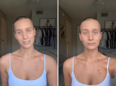 Encontrei um caroço na clavícula – o diagnóstico virou minha vida de cabeça para baixo Encontrei um caroço na clavícula – o diagnóstico virou minha vida de cabeça para baixo