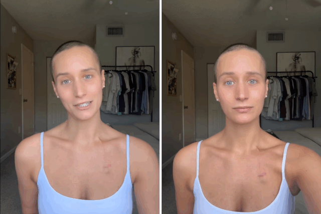 Encontrei um caroço na clavícula – o diagnóstico virou minha Encontrei um caroço na clavícula – o diagnóstico virou minha vida de cabeça para baixo