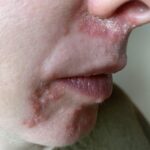 Minha pele, duas semanas depois do início da condição... não vi nenhum progresso