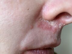 Essa doença de pele pouco conhecida arruinou minha vida. Não é acne, eczema ou mesmo rosácea – mas uma combinação dos três que surge do nada e afeta milhares de pessoas. Estes são os sinais a serem observados – e como finalmente tratei Minha pele, duas semanas depois do início da condição... não vi nenhum progresso