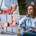 Esses alimentos podem estar impulsionando o aumento do câncer colorretal de início precoce em mulheres