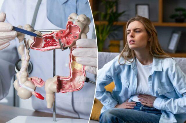 Esses alimentos podem estar impulsionando o aumento do câncer colorretal de início precoce em mulheres
