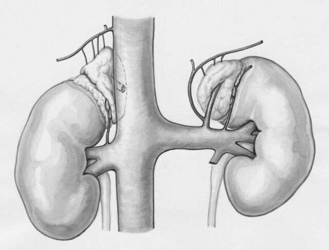 Estudo global constata mortalidade estável por lesão renal aguda com rim