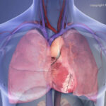 Melhorar o tratamento de coágulos sanguíneos potencialmente fatais