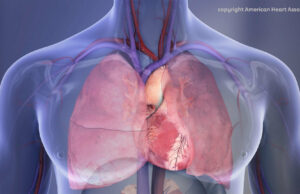 Melhorar o tratamento de coágulos sanguíneos potencialmente fatais Melhorar o tratamento de coágulos sanguíneos potencialmente fatais