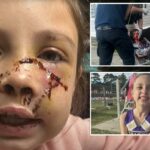 Menina do Alabama, 9 anos, atacada por cachorro que ‘agarrou’ seu rosto, deixando ferimentos brutais