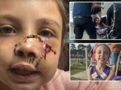 Menina do Alabama, 9 anos, atacada por cachorro que ‘agarrou’ seu rosto, deixando ferimentos brutais Menina do Alabama, 9 anos, atacada por cachorro que ‘agarrou’ seu rosto, deixando ferimentos brutais