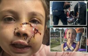 Menina do Alabama, 9 anos, atacada por cachorro que ‘agarrou’ seu rosto, deixando ferimentos brutais Menina do Alabama, 9 anos, atacada por cachorro que ‘agarrou’ seu rosto, deixando ferimentos brutais