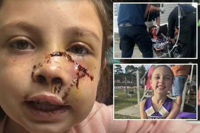 Menina do Alabama, 9 anos, atacada por cachorro que ‘agarrou’ Menina do Alabama, 9 anos, atacada por cachorro que ‘agarrou’ seu rosto, deixando ferimentos brutais