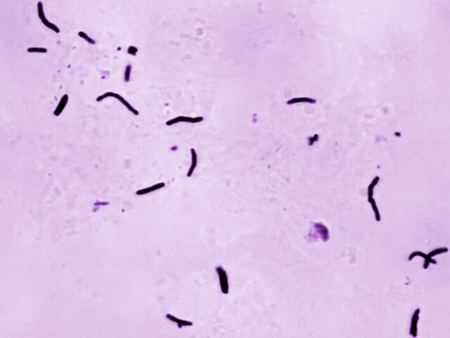 Tuberculose matou 1,23 milhão de pessoas no ano passado, diz OMS
