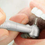 Bactéria oral pode piorar a incapacidade em pacientes com esclerose múltipla: Estudo