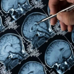 Estudo indo-alemão liga desequilíbrio de bactérias intestinais à memória e declínio cognitivo