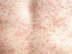 Giroir: RFK Jr. precisa defender ‘incondicionalmente’ a vacina contra o sarampo, falta de vacinação causando mortes, surto Giroir: RFK Jr. precisa defender 'incondicionalmente' a vacina contra o sarampo, falta de vacinação causando mortes, surto