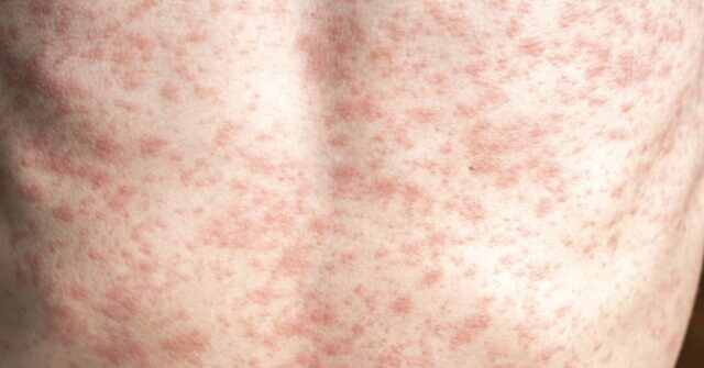 Giroir: RFK Jr. precisa defender 'incondicionalmente' a vacina contra o Giroir: RFK Jr. precisa defender 'incondicionalmente' a vacina contra o sarampo, falta de vacinação causando mortes, surto