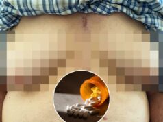 Homem de 76 anos cresce seios após tomar medicação comum usada para tratar hipertensão e queda de cabelo Parte superior do tronco de um homem de 76 anos, com cicatriz visível na parte superior do tórax.