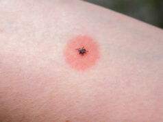 Médicos emitem alerta sobre doenças ‘potencialmente fatais’ transmitidas por insetos de quintal difíceis de detectar: ’Ainda não há cura’ Yahoo news home