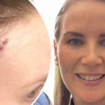 História de câncer de pele - Sara, mulher de Melbourne