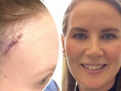 Pequena mancha encontrada na testa de Sara mata 700 australianos todos os anos História de câncer de pele - Sara, mulher de Melbourne