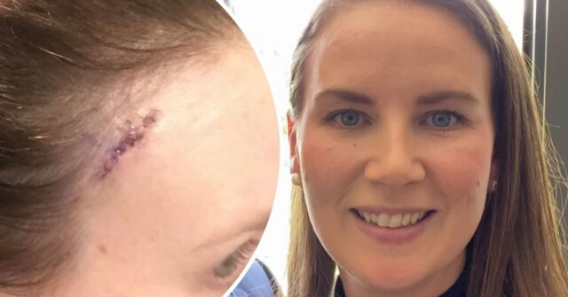 Pequena mancha encontrada na testa de Sara mata 700 australianos História de câncer de pele - Sara, mulher de Melbourne