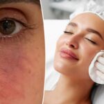 Preenchimentos cosméticos podem causar perda de pele e até cegueira devido a complicações assustadoras, alertam os médicos