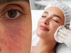 Preenchimentos cosméticos podem causar perda de pele e até cegueira devido a complicações assustadoras, alertam os médicos Preenchimentos cosméticos podem causar perda de pele e até cegueira devido a complicações assustadoras, alertam os médicos