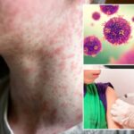 A assustadora complicação do sarampo que faz seu corpo esquecer como combater outras infecções – à medida que os casos aumentam para o maior nível em 30 anos