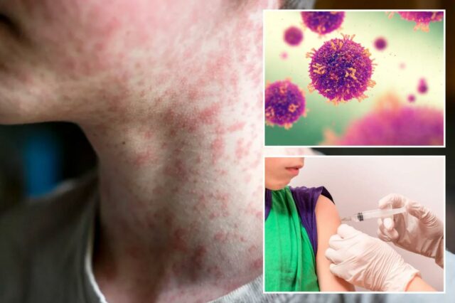 A assustadora complicação do sarampo que faz seu corpo esquecer como combater outras infecções – à medida que os casos aumentam para o maior nível em 30 anos
