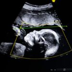 Biotics AI, Battlefield 2023, obtém aprovação da FDA para seu produto de ultrassom fetal alimentado por IA