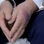 O grande hematoma preto e vermelho visto na mão de Donald Trump.