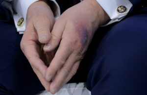 Enorme hematoma visto na mão de Donald Trump O grande hematoma preto e vermelho visto na mão de Donald Trump.