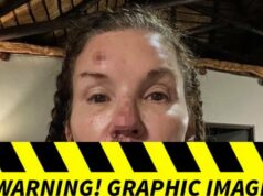 Fotos de Janice Dickinson de supostas lesões causadas por uma queda desagradável em ‘I’m A Celebrity’ Janice-Dickinson-sub-getty-1