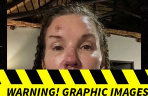 Fotos de Janice Dickinson de supostas lesões causadas por uma queda desagradável em ‘I’m A Celebrity’ Janice-Dickinson-sub-getty-1