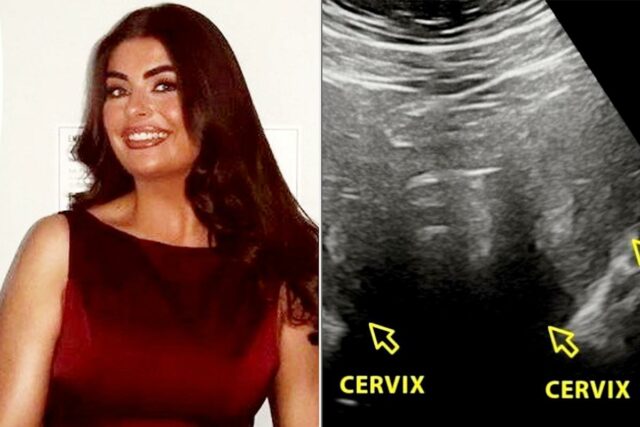 Mulher teve períodos intensos. Após a cirurgia aos 19 anos, Ellie Curran SWNS