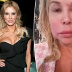 Brandi Glanville finalmente revela o que causou o parasita facial que a envelheceu '20 anos durante a noite'