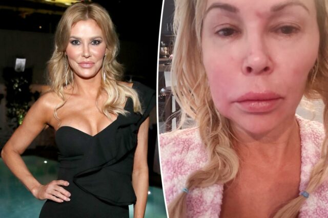 Brandi Glanville finalmente revela o que causou o parasita facial que a envelheceu '20 anos durante a noite'

