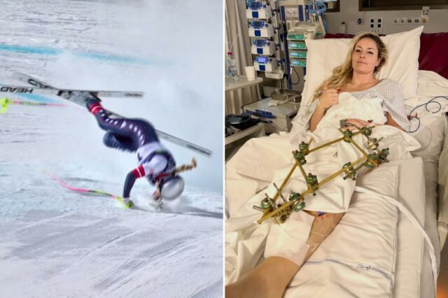 Enquanto Lindsey Vonn enfrenta uma longa recuperação, este é o preço que as Olimpíadas cobram do corpo dos atletas
