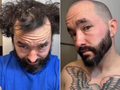 Heróis sem pelos! Dentro da comunidade on-line onde homens carecas incentivam uns aos outros a raspar a cabeça – e elogiam seus novos looks surpreendentes Um usuário do fórum Reddit r/bald mostra sua transformação impressionante depois de raspar o cabelo ralo