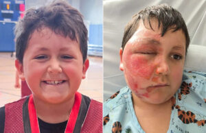 Menino de 9 anos que ficou com queimaduras graves no rosto depois de tentar uma tendência perigosa nas redes sociais se torna a quarta criança a precisar de tratamento em um hospital local Yahoo news home