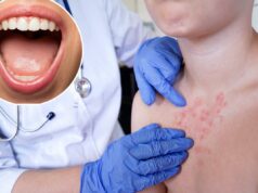 O que são ‘manchas de Koplik’? O sinal sorrateiro de sarampo que você pode ter antes de uma erupção na pele Close extremo da boca aberta de uma jovem com dentes brancos perfeitos e uma língua rosada.