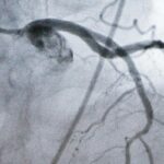 Um monitor mostrando uma artéria durante um procedimento cardíaco em laboratório de cateterismo.