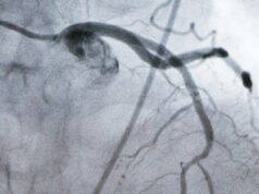 Pesquisadores descobrem que pílula experimental para baixar o colesterol pode dar a milhões de pessoas uma nova opção Um monitor mostrando uma artéria durante um procedimento cardíaco em laboratório de cateterismo.